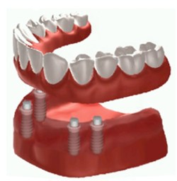 Schaubild Unterkiefer-Locator-Verankerung
