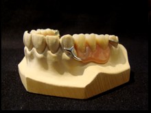 Modellgußprothese Modellgußprothese