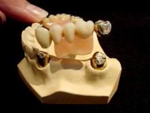 Teleskopprothese Teleskopprothese