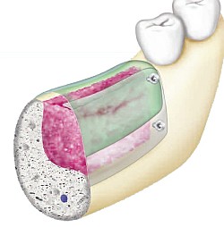 Schaubild SonicWeld Rx®