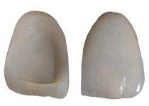 Veneers - dünne Haftschalen Veneers - dünne Haftschalen